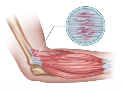 Tennis Elbow Causes, Symptoms & Treatment - Tennis Uni